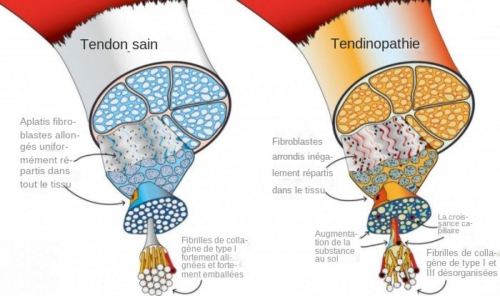 TendinopathyAnatomy2-e1562733760259 apparition tendinopathie