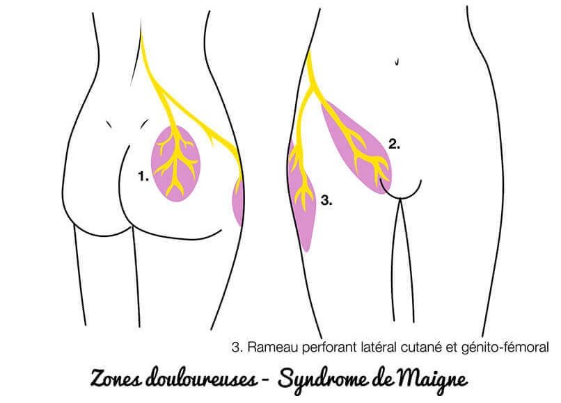 syndrome de maigne